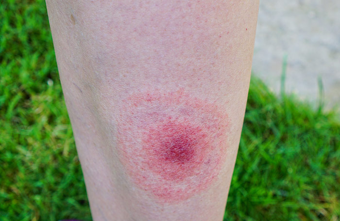 Lyme Disease Bullseye on person's thigh